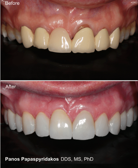 Dental Crowns in Peabody - Full Mouth Rehabilitation - Contemporary Dentistry and Implantology