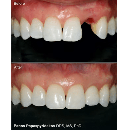 Oral Surgery in Peabody at Contemporary Dentistry and Implantology