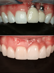 Dental Implants 1 NEW