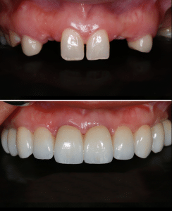 Dental Implants 8