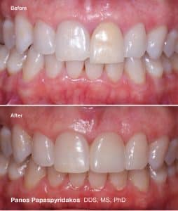 Dental implants 10