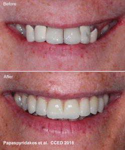 Dental implants 13