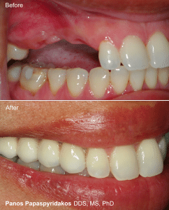 Dental implants 14