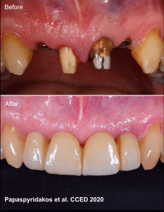 Dental implants 16 NEW