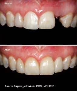 Dental implants 2