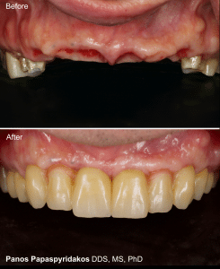 Dental implants 3