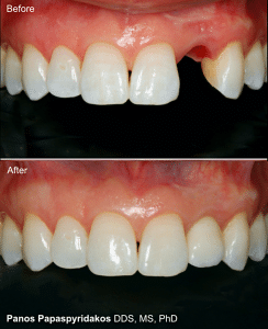 Dental implants 4