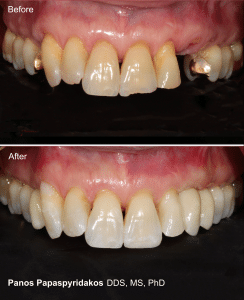 Dental implants 5