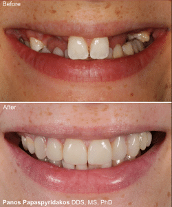 Dental implants 6