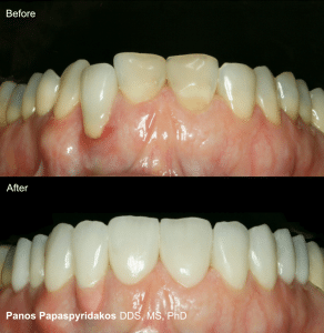 Dental implants 7