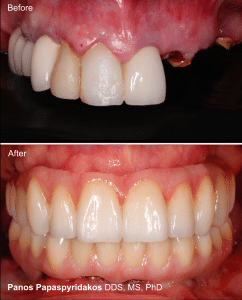 Full Arch Rehabilitation 13