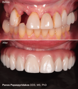 Full Arch Rehabilitation 3