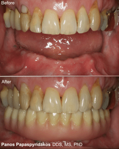 Full Arch Rehabilitation 4