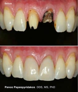 Porcelain crowns 1