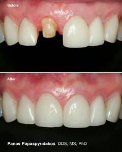 Porcelain crowns 2