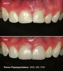 Porcelain crowns 4