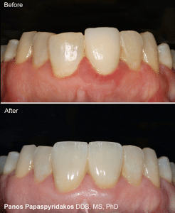 Porcelain crowns 9