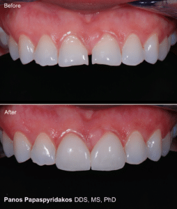 Before and After Smile Gallery - The Best Veneers in Peabody