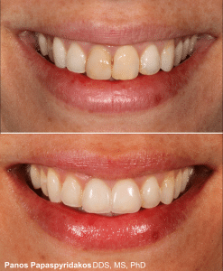 Veneers 11