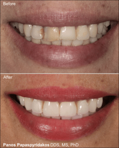 Veneers 12