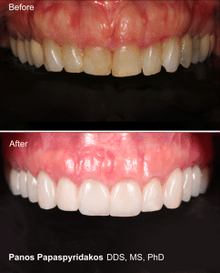 Veneers 14