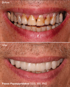 Veneers 17