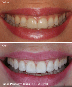 Veneers 18