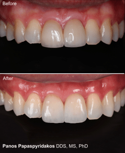 Veneers 21