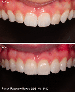 Veneers 27